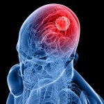 تومور مغزی ایجاد شده به وسیله امواج الکترومغناطیس خارج از استاندارد