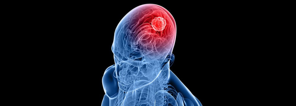 تومور مغزی ایجاد شده به وسیله امواج الکترومغناطیس خارج از استاندارد