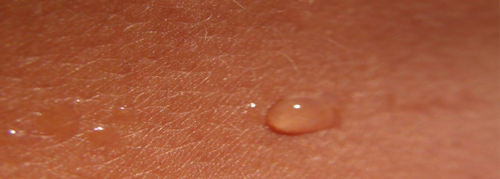 تاثیر امواج الکترومغناطیس بر پوست